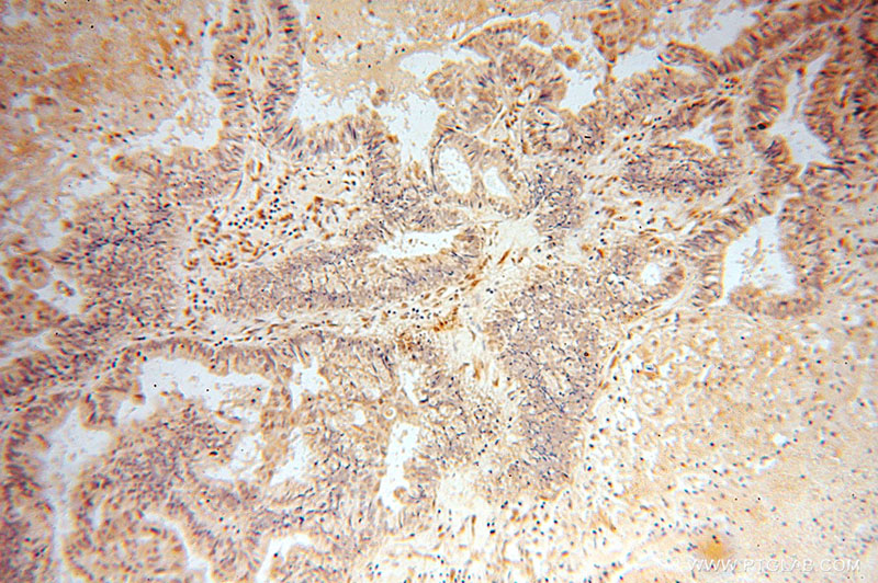 Immunohistochemical of paraffin-embedded human ovary tumor using Catalog No:114567(RBPMS antibody) at dilution of 1:50 (under 10x lens)