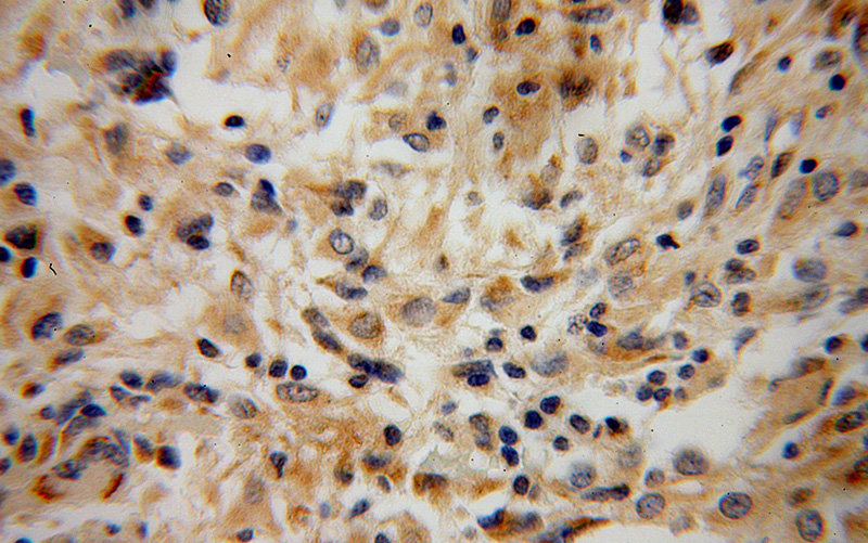 Immunohistochemical of paraffin-embedded human gliomas using Catalog No:112014(KIF3C antibody) at dilution of 1:100 (under 40x lens)