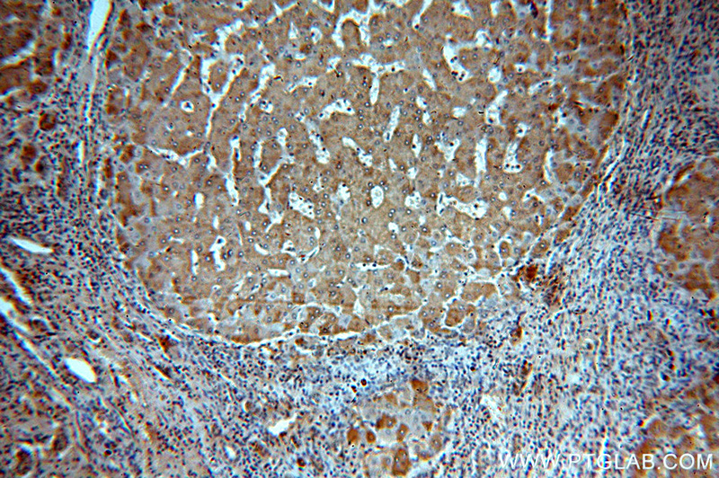 Immunohistochemical of paraffin-embedded human hepatocirrhosis using Catalog No:108941(CBR4 antibody) at dilution of 1:50 (under 10x lens)