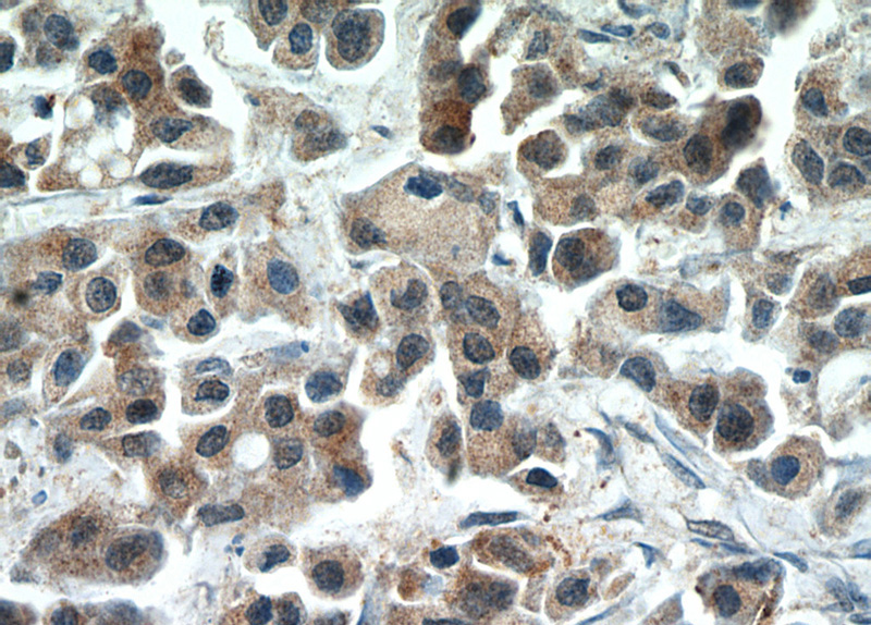 Immunohistochemical of paraffin-embedded human breast cancer using Catalog No:114692(RERG antibody) at dilution of 1:50 (under 40x lens)
