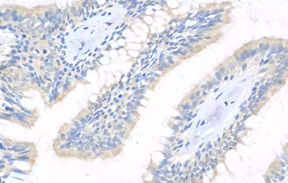 Immunohistochemical of paraffin-embedded human lung cancer using Catalog No:114678(REDD1 antibody) at dilution of 1:50 (under 40x lens)