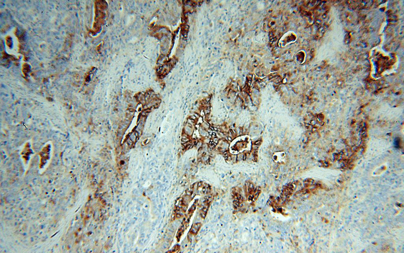 Immunohistochemical of paraffin-embedded human stomach cancer using Catalog No:116011(TFF2 antibody) at dilution of 1:50 (under 10x lens)