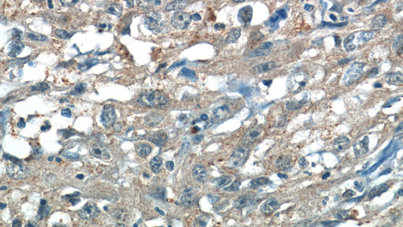 Immunohistochemistry of paraffin-embedded human cervical cancer tissue slide using Catalog No:111890(JNK Antibody) at dilution of 1:50 (under 40x lens)