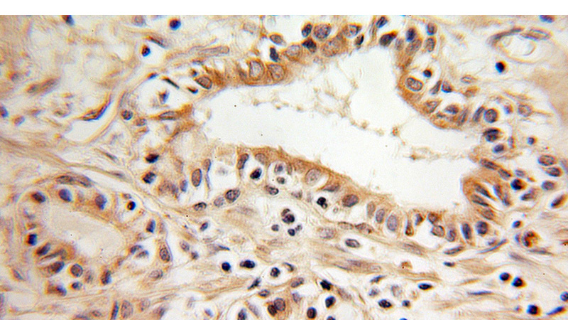 Immunohistochemical of paraffin-embedded human prostate cancer using Catalog No:114865(RTN4 antibody) at dilution of 1:100 (under 10x lens)