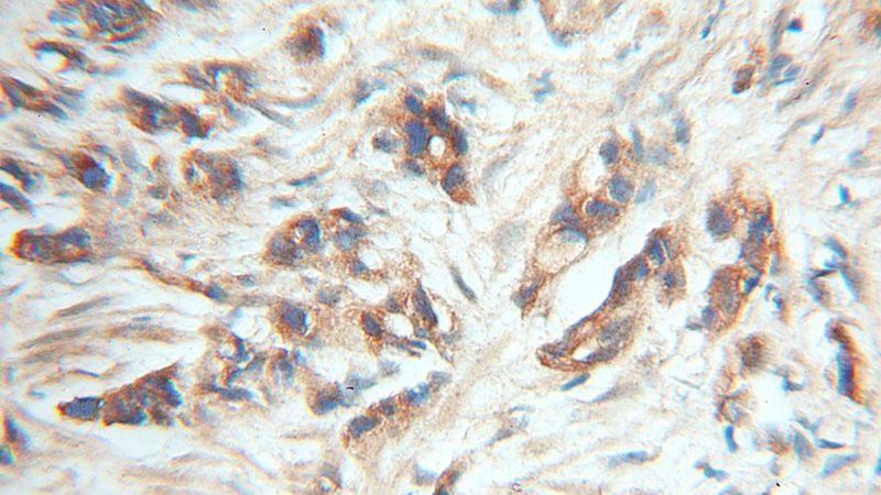 Immunohistochemical of paraffin-embedded human prostate cancer using Catalog No:110777(FRS2 antibody) at dilution of 1:50 (under 10x lens)