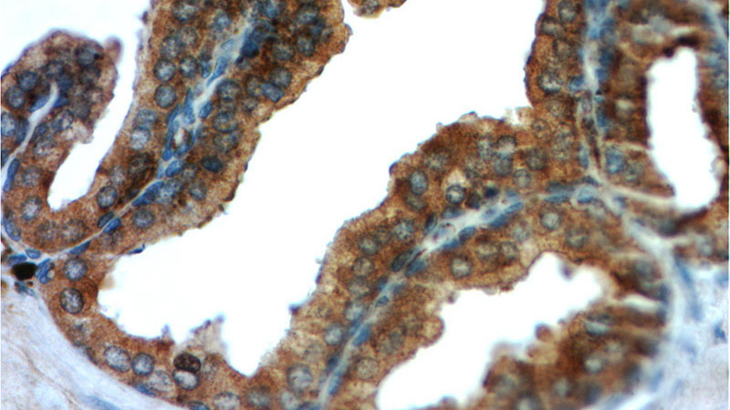 Immunohistochemistry of paraffin-embedded human prostate cancer tissue slide using Catalog No:114290(PSAP Antibody) at dilution of 1:50 (under 40x lens)