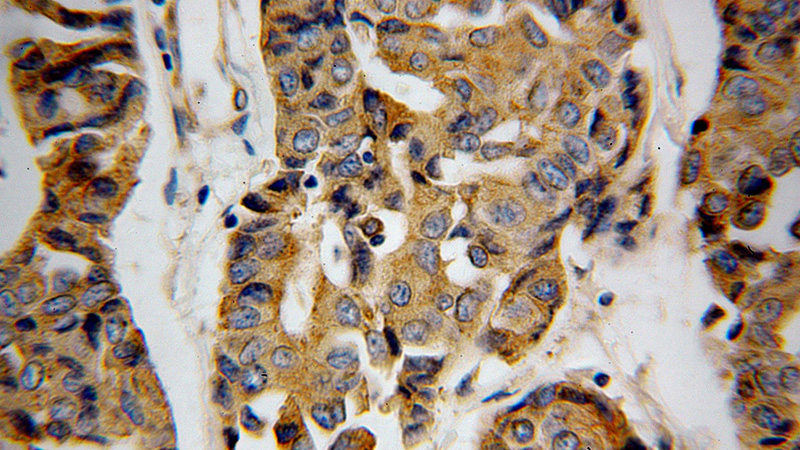 Immunohistochemical of paraffin-embedded human breast cancer using Catalog No:108832(CANX antibody) at dilution of 1:100 (under 40x lens)