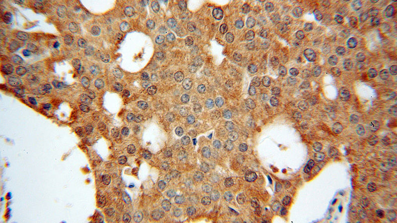 Immunohistochemical of paraffin-embedded human prostate cancer using Catalog No:110242(EML2 antibody) at dilution of 1:100 (under 40x lens)