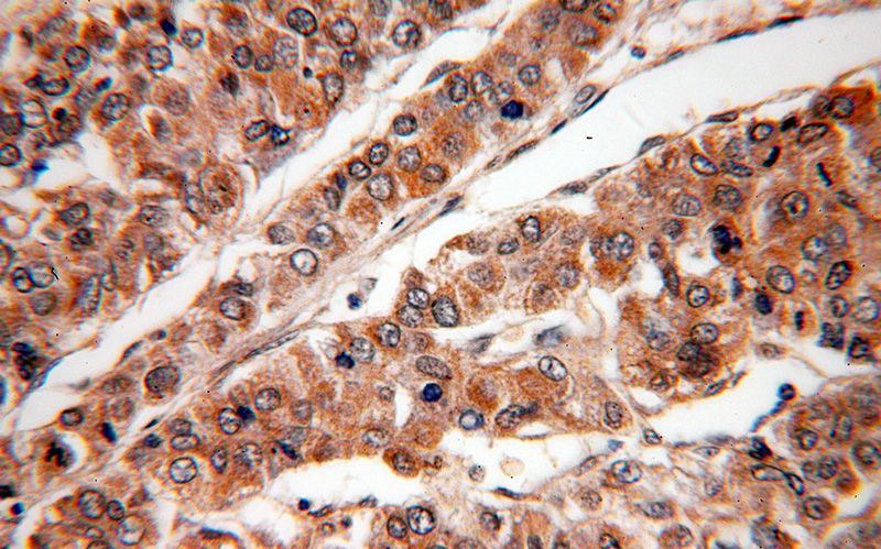 Immunohistochemical of paraffin-embedded human liver cancer using Catalog No:113611(PXN antibody) at dilution of 1:50 (under 40x lens)