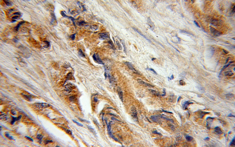 Immunohistochemical of paraffin-embedded human prostate cancer using Catalog No:110831(Galc antibody) at dilution of 1:50 (under 10x lens)