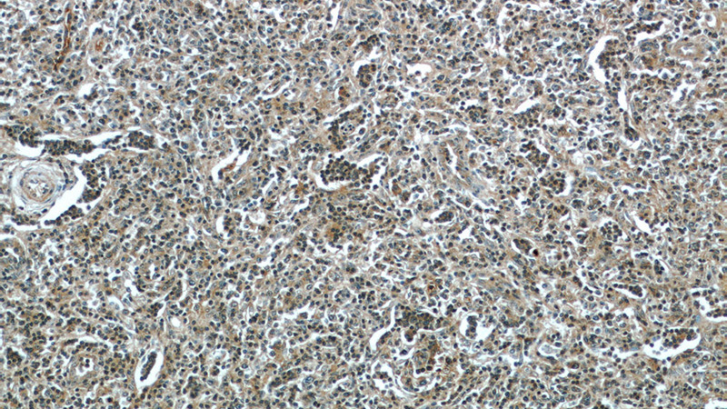 Immunohistochemistry of paraffin-embedded human lymphoma tissue slide using (CLEC11A Antibody) at dilution of 1:50 (under 10x lens)