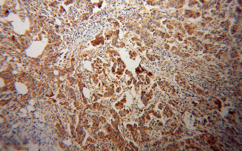 Immunohistochemical of paraffin-embedded human prostate cancer using Catalog No:109681(CYP17A1 antibody) at dilution of 1:100 (under 10x lens)