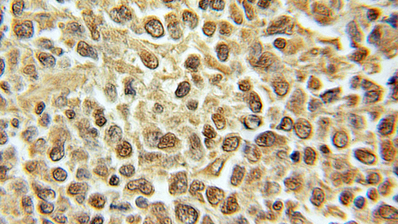 Immunohistochemical of paraffin-embedded human lymphoma using Catalog No:114192(PRIM1 antibody) at dilution of 1:100 (under 10x lens)