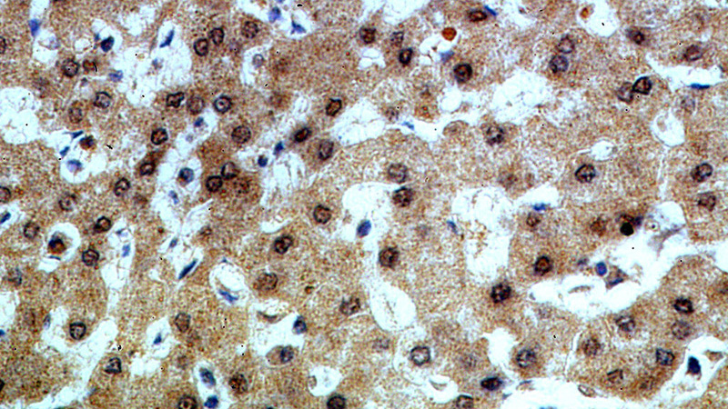Immunohistochemical of paraffin-embedded human hepatocirrhosis using Catalog No:116401(TRNAU1AP,SECP43 antibody) at dilution of 1:50 (under 40x lens)