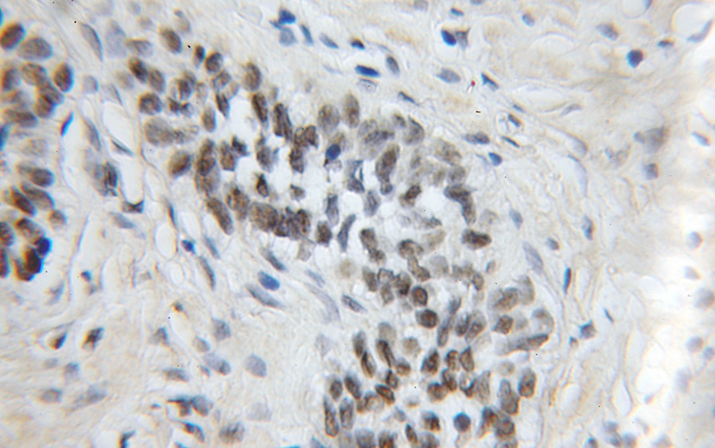 Immunohistochemical of paraffin-embedded human prostate cancer using Catalog No:112742(MPG antibody) at dilution of 1:50 (under 10x lens)