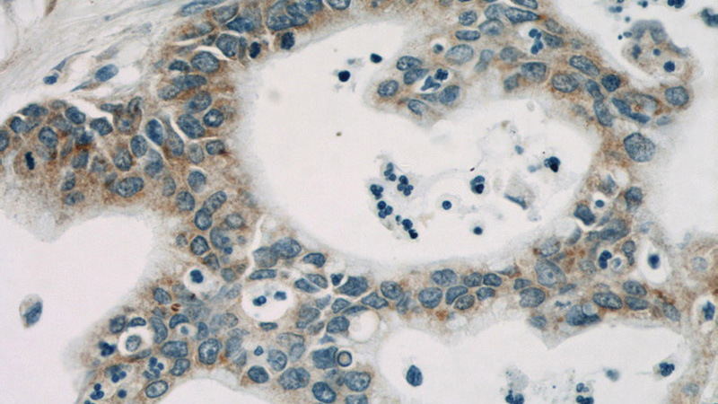 Immunohistochemical of paraffin-embedded human pancreas cancer using Catalog No:107225(PPIB antibody) at dilution of 1:50 (under 40x lens)