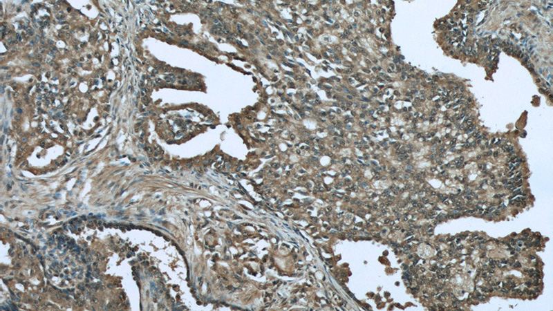 Immunohistochemistry of paraffin-embedded human prostate cancer tissue slide using Catalog No:109732(C1QTNF1 Antibody) at dilution of 1:50 (under 10x lens)