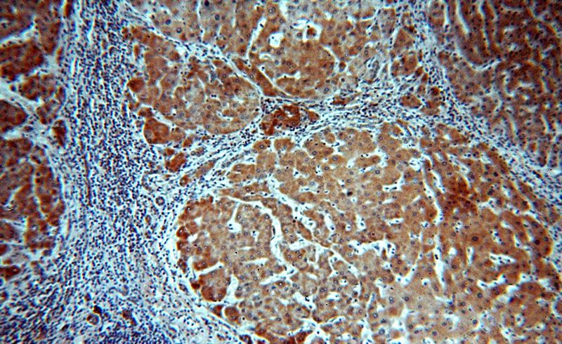Immunohistochemical of paraffin-embedded human hepatocirrhosis using Catalog No:116475(UBASH3B antibody) at dilution of 1:100 (under 10x lens)