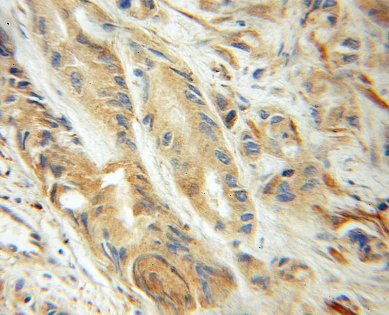 Immunohistochemical of paraffin-embedded human prostate cancer using Catalog No:116510(UBC9 antibody) at dilution of 1:100 (under 10x lens)