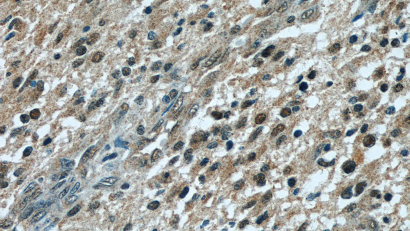 Immunohistochemical of paraffin-embedded human gliomas using Catalog No:110707(FOXO6 antibody) at dilution of 1:50 (under 40x lens)