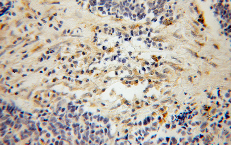 Immunohistochemical of paraffin-embedded human lung cancer using Catalog No:113600(PARVG antibody) at dilution of 1:100 (under 10x lens)