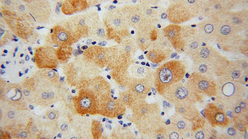 Immunohistochemical of paraffin-embedded human liver cancer using Catalog No:110941(GEMIN8 antibody) at dilution of 1:50 (under 40x lens)