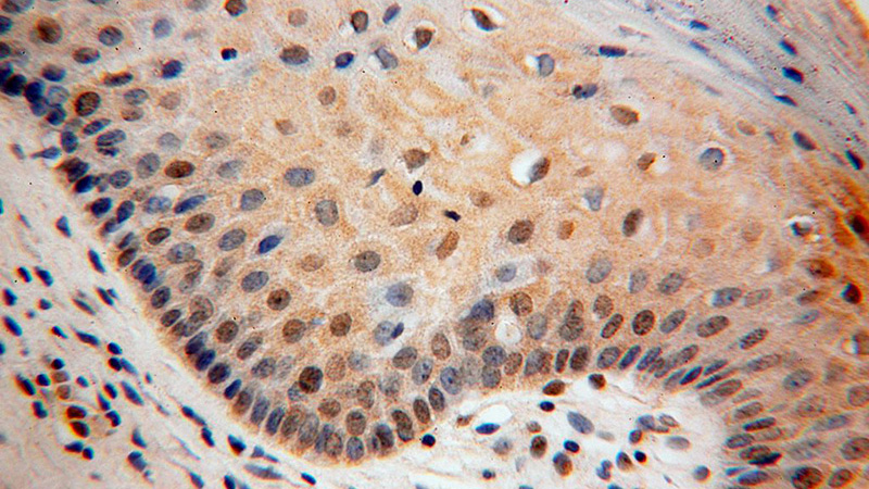 Immunohistochemical of paraffin-embedded human cervix using Catalog No:116613(UNC45A antibody) at dilution of 1:100 (under 40x lens)