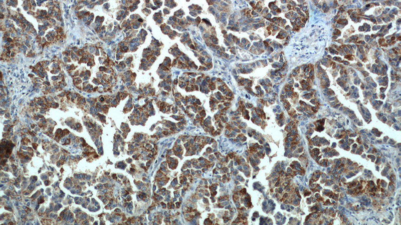 Immunohistochemistry of paraffin-embedded human lung cancer slide using Catalog No:112908(MX1 Antibody) at dilution of 1:50