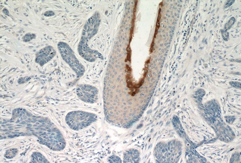 Immunohistochemistry of paraffin-embedded human skin cancer tissue slide using Catalog No:110272(PI3 Antibody) at dilution of 1:50 (under 10x lens)