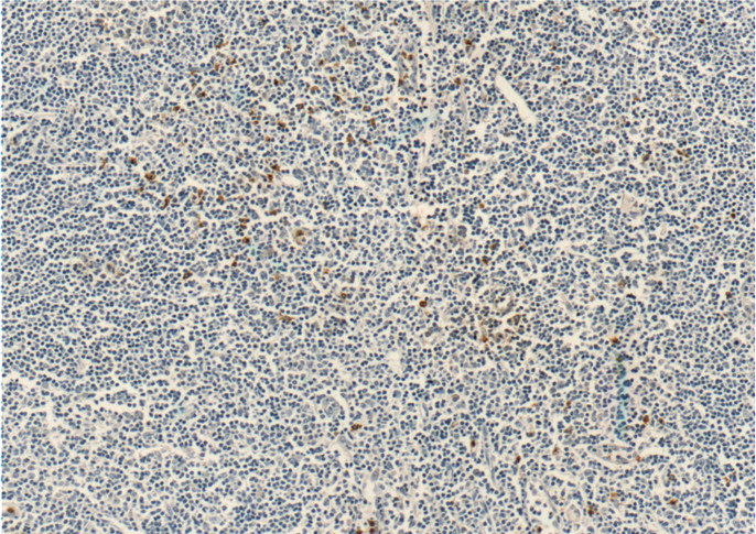 Immunohistochemistry of paraffin-embedded human tonsillitis tissue slide using Catalog No:109076(CCR3 Antibody) at dilution of 1:200 (under 10x lens)