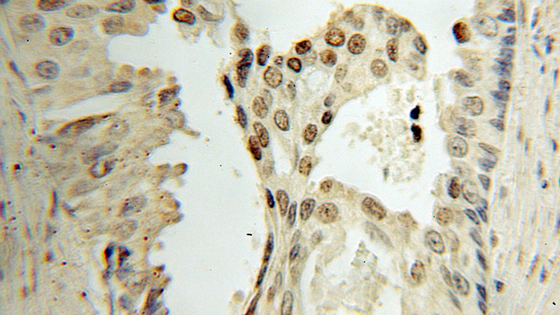 Immunohistochemical of paraffin-embedded human prostate cancer using Catalog No:109853(DACH1 antibody) at dilution of 1:50 (under 10x lens)