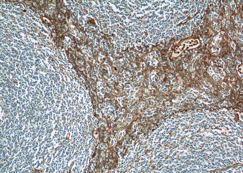 Immunohistochemistry of paraffin-embedded human tonsillitis tissue slide using Catalog No:107768(ADAM8 Antibody) at dilution of 1:50 (under 10x lens)