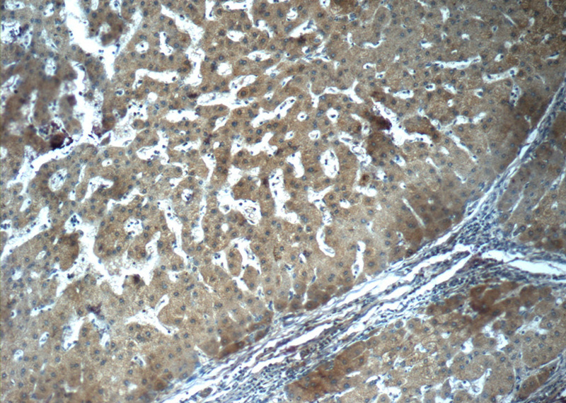 Immunohistochemistry of paraffin-embedded human hepatocirrhosis tissue slide using Catalog No:110657(FGG Antibody) at dilution of 1:50 (under 10x lens)