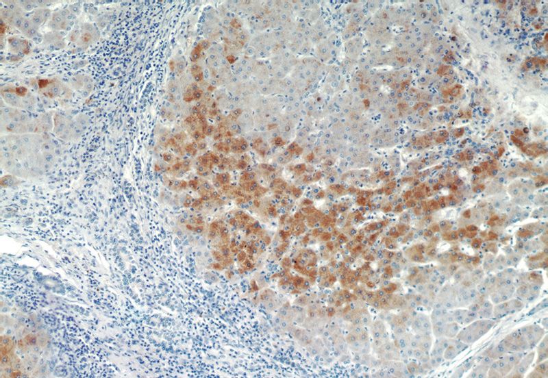 Immunohistochemistry of paraffin-embedded human hepatocirrhosis tissue slide using Catalog No:108400(BAAT Antibody) at dilution of 1:100 (under 10x lens)