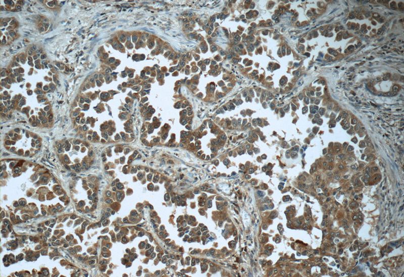 Immunohistochemistry of paraffin-embedded human lung cancer tissue slide using Catalog No:110214(KIF11 Antibody) at dilution of 1:50 (under 10x lens)