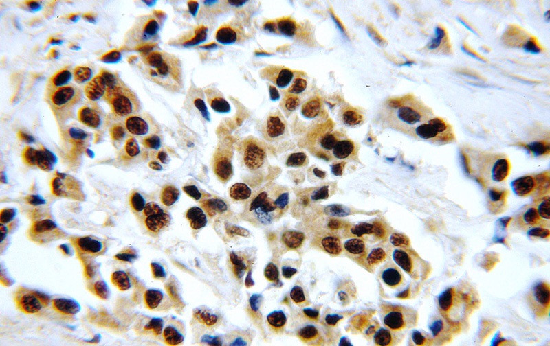 Immunohistochemical of paraffin-embedded human breast cancer using Catalog No:111706(HTATSF1 antibody) at dilution of 1:100 (under 40x lens)