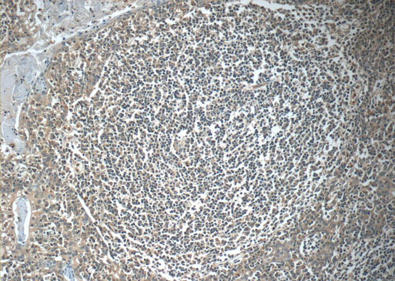 Immunohistochemistry of paraffin-embedded human tonsillitis tissue slide using Catalog No:112975(MYLK4 Antibody) at dilution of 1:50 (under 10x lens)