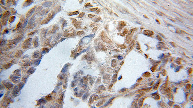 Immunohistochemical of paraffin-embedded human ovary tumor using Catalog No:110280(ELL antibody) at dilution of 1:50 (under 10x lens)
