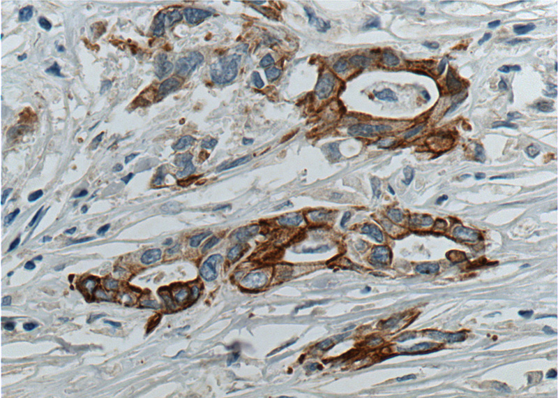 Immunohistochemistry of paraffin-embedded human pancreas cancer tissue slide using Catalog No:111087(GPC1 Antibody) at dilution of 1:200 (under 40x lens). heat mediated antigen retrieved with Tris-EDTA buffer(pH9).