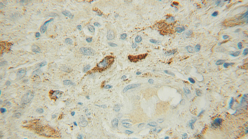 Immunohistochemical of paraffin-embedded human gliomas using Catalog No:111821(IPPK antibody) at dilution of 1:100 (under 10x lens)