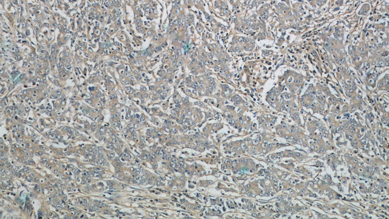 Immunohistochemistry of paraffin-embedded human stomach cancer tissue slide using Catalog No:110561(FBXW11 Antibody) at dilution of 1:100 (under 10x lens).