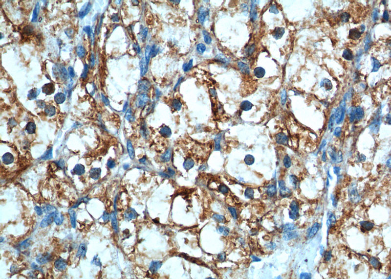 Immunohistochemistry of paraffin-embedded human renal cell carcinoma tissue slide using Catalog No:108913(CAMK2A Antibody) at dilution of 1:200 (under 40x lens).