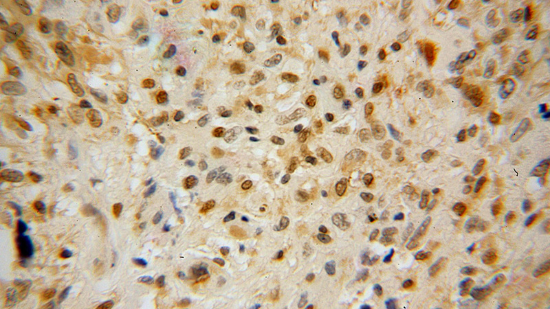 Immunohistochemical of paraffin-embedded human gliomas using Catalog No:113519(OTX2 antibody) at dilution of 1:100 (under 40x lens)