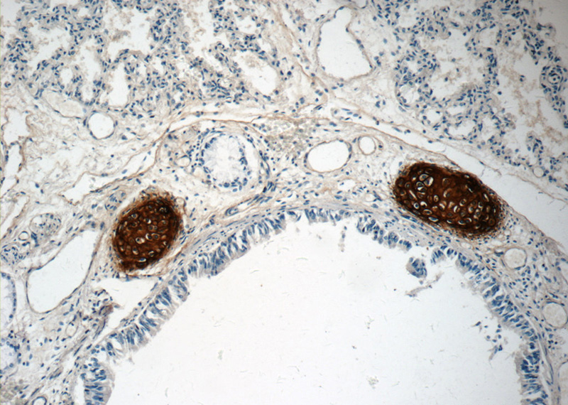 Immunohistochemistry of paraffin-embedded human lung tissue slide using Catalog No:107829(ACAN Antibody) at dilution of 1:400 (under 10x lens)