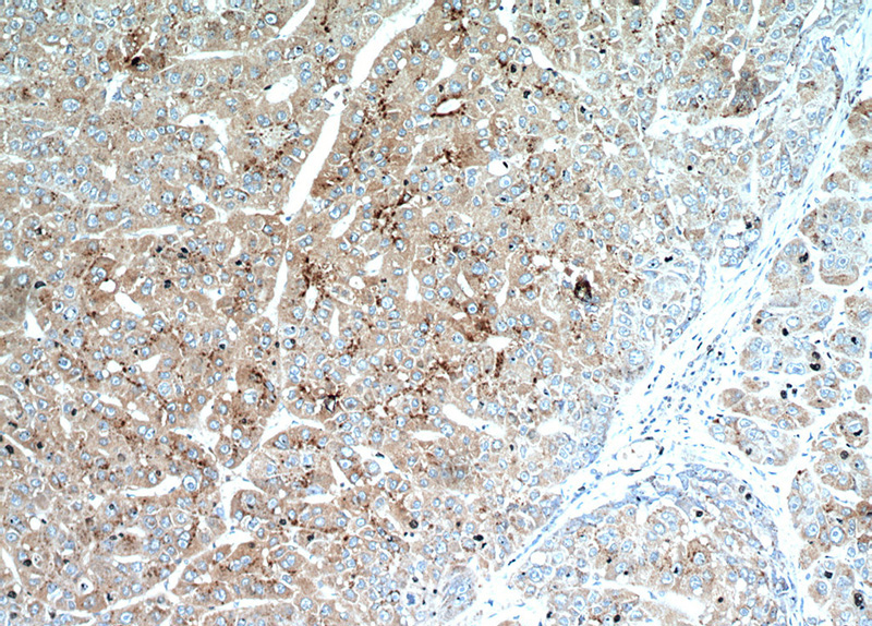 Immunohistochemical of paraffin-embedded human liver cancer using Catalog No:115219(SET antibody) at dilution of 1:100 (under 10x lens)