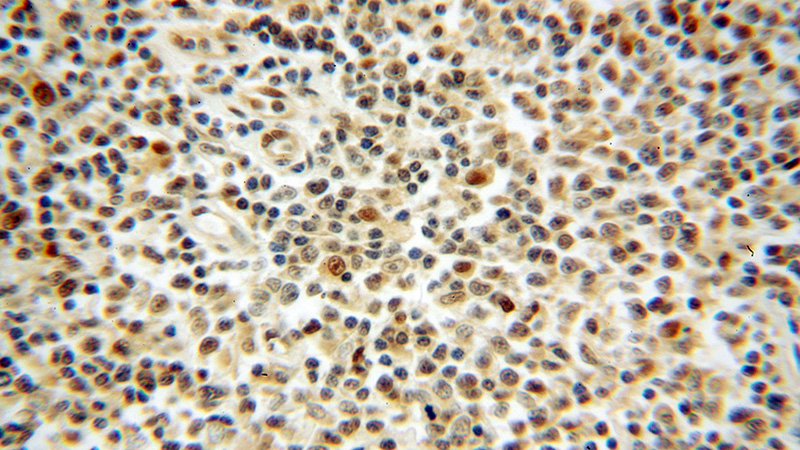Immunohistochemical of paraffin-embedded human lymphoma using Catalog No:112286(PSMB9 antibody) at dilution of 1:50 (under 40x lens)