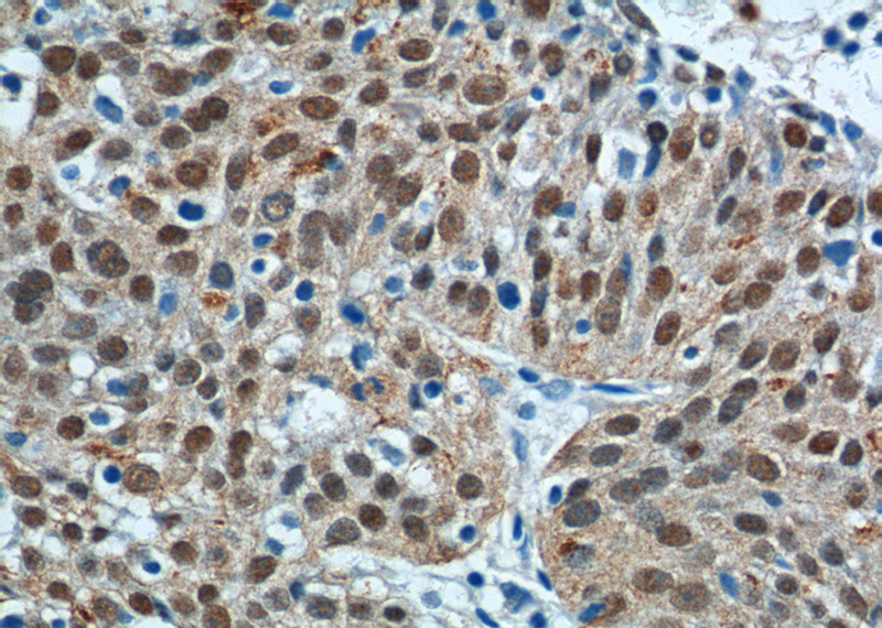 Immunohistochemistry of paraffin-embedded human lung cancer tissue slide using Catalog No:115515(SOX2 Antibody) at dilution of 1:200 (under 40x lens).