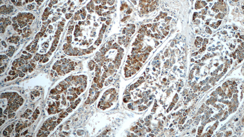 Immunohistochemistry of paraffin-embedded human liver cancer tissue slide using Catalog No:108679(C1orf56 Antibody) at dilution of 1:50 (under 10x lens)