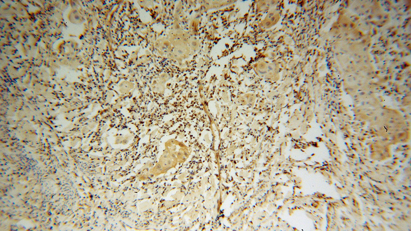 Immunohistochemical of paraffin-embedded human cervical cancer using Catalog No:115687(STAT3 antibody) at dilution of 1:100 (under 10x lens)