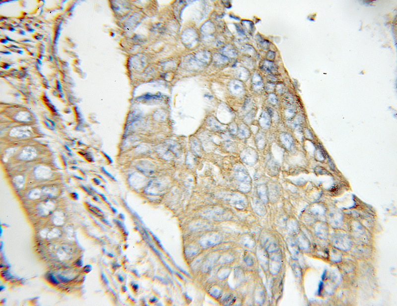Immunohistochemical of paraffin-embedded human colon cancer using Catalog No:110417(EXT2 antibody) at dilution of 1:50 (under 10x lens)